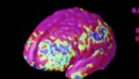 Imaging of a brain